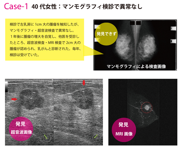 乳がん検診画像ケース1