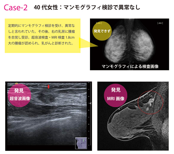 乳がん検診画像ケース2
