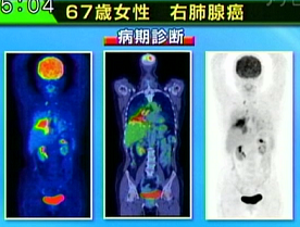 早期の大腸癌の画像